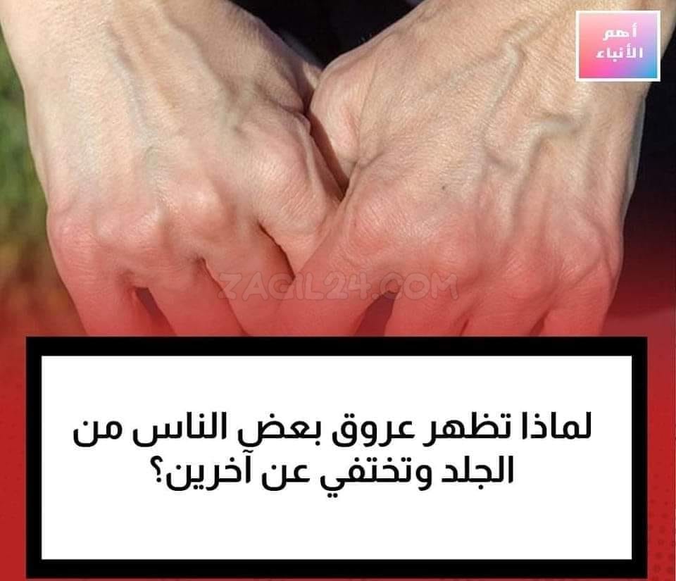 لماذا تظهر عروق بعض الناس من الجلد وتختفي عند آخرين؟