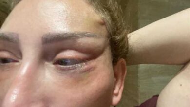 ريهام سعيد فشل عملية التجميل